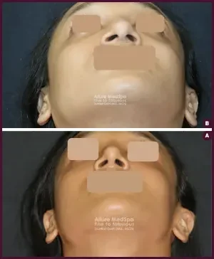 2018-04-031-COMPLETE-RHINOPLASTY-1