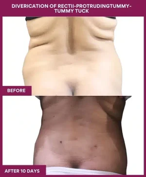 3 DIVERICATION OF RECTII-PROTRUDINGTUMMY- TUMMY TUCK (3)_7_