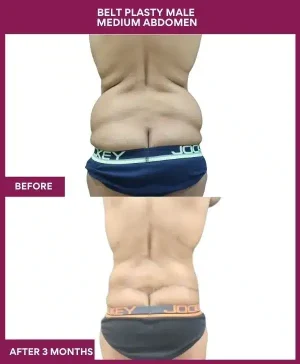 4 BELT PLASTY MALE MEDIUM ABDOMEN (3)_11