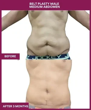 4 BELT PLASTY MALE MEDIUM ABDOMEN (4)_11