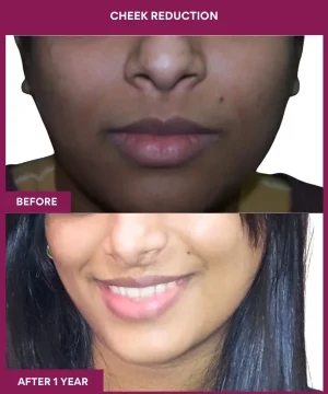 4 Cheek Reduction_9_