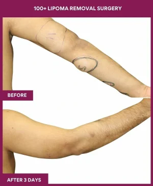 5 100+ Lipoma Removal Surgery (2)