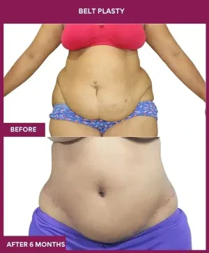 5 BELT PLASTY_15_ (4)