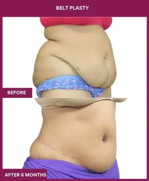 5 BELT PLASTY_15_ (5)