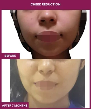 5 Cheek Reduction (2)_22_