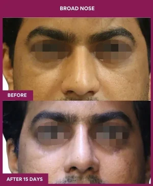 6 BROAD NOSE_18_ (1)