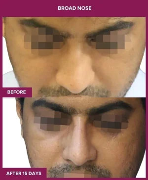 6 BROAD NOSE_18_ (2)