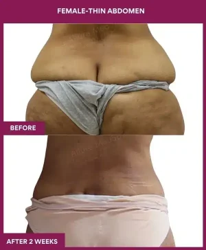 6 FEMALE-THIN ABDOMEN_18_ (2)