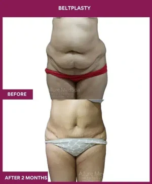 7 BELTPLASTY_21_ (4)