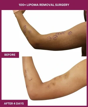 8 100+ Lipoma Removal Surgery