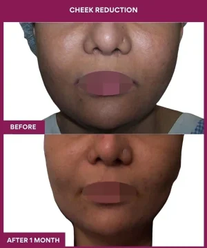 8 Cheek Reduction_26_