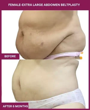8 FEMALE-EXTRA LARGE ABDOMEN BELTPLASTY_ (1)