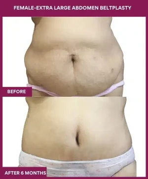 8 FEMALE-EXTRA LARGE ABDOMEN BELTPLASTY_ (2)