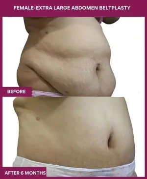 8 FEMALE-EXTRA LARGE ABDOMEN BELTPLASTY_ (3)