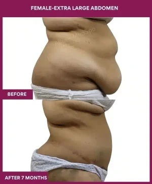 9 FEMALE-EXTRA LARGE ABDOMEN_ (2)