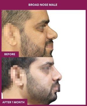 BROAD NOSE MALE Surgery In Mumbai, India