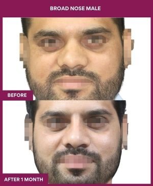 BROAD NOSE MALE Surgery In Mumbai, India