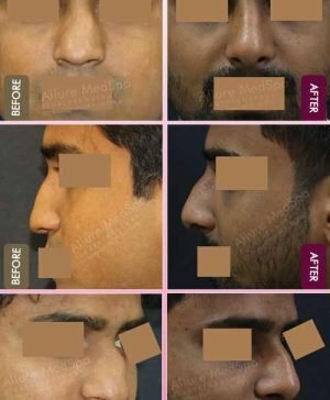 Crooked-Nose-Surgery-Before-and-After-Photos-in-Mumbai-India