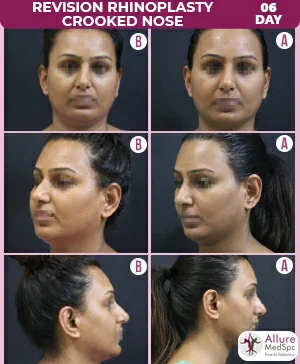Revision_Rhinoplasty_Crooked_Nose