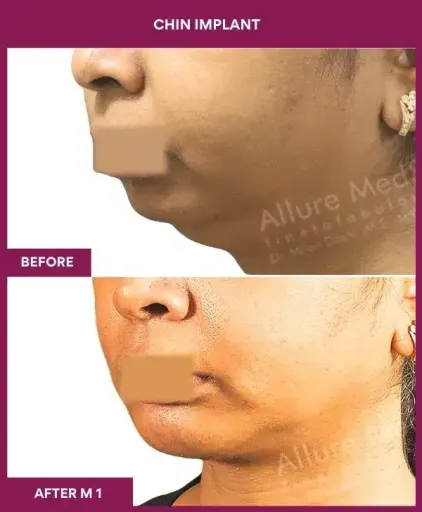 4 Chin Implant in Mumbai, India