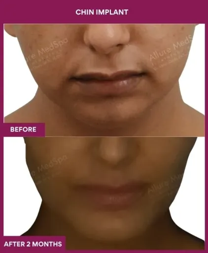 14 Chin Implant (4)_39_