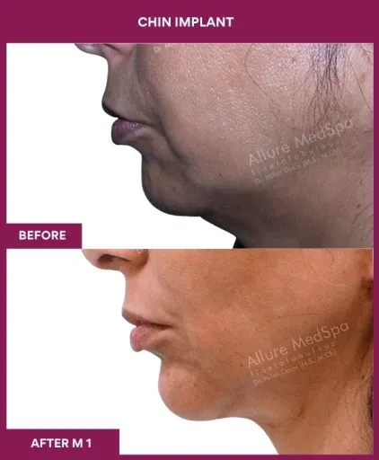 5 Chin Implant (3)_13_