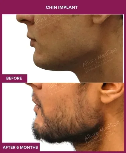 6 Chin Implant (3)_17
