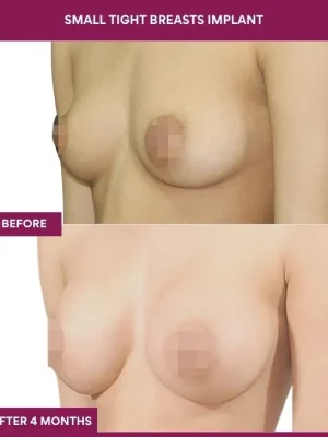 2 Small Tight Breasts Implant (5)_5_
