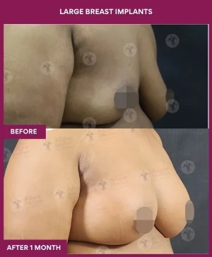 3 Large Breast Implants (5)_8