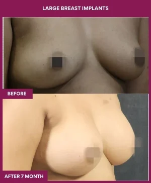 4 Large Breast Implants_12_ (2)