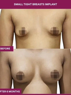 4 Small Tight Breasts Implant_12_ (1)