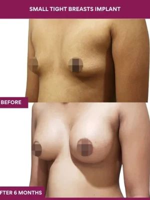 4 Small Tight Breasts Implant_12_ (2)