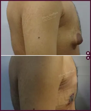 GYNAECOMASTIA_GRADE_03_BF_AFTER-MASSIVE-WEIGHT-LOSS-copy-1