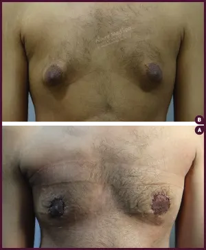 GYNAECOMASTIA_GRADE_03_BF_AFTER-MASSIVE-WEIGHT-LOSS-copy-3