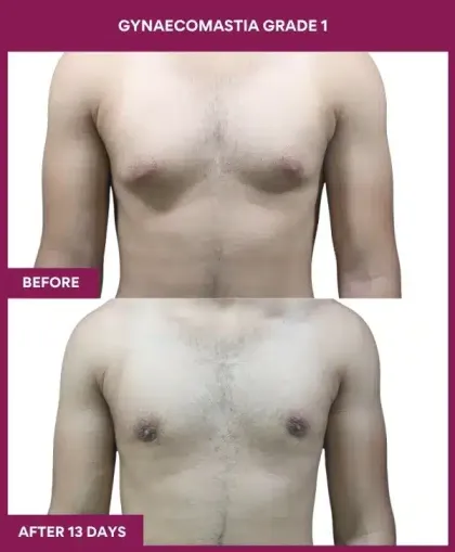 Gynecomastia Surgery Grade 1 Before After image in Mumbai, India