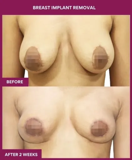 1- Breast implant removal_3_ (1)