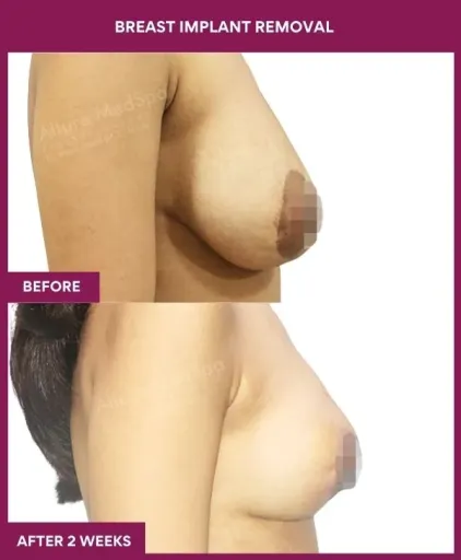1- Breast implant removal_3_ (2)