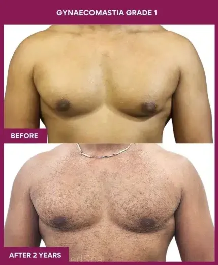 1-GYNAECOMASTIA GRADE 1