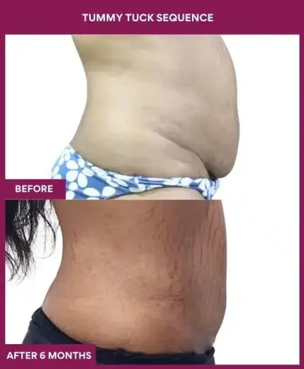 1 TUMMY TUCK SEQUENCE_3_ (2)