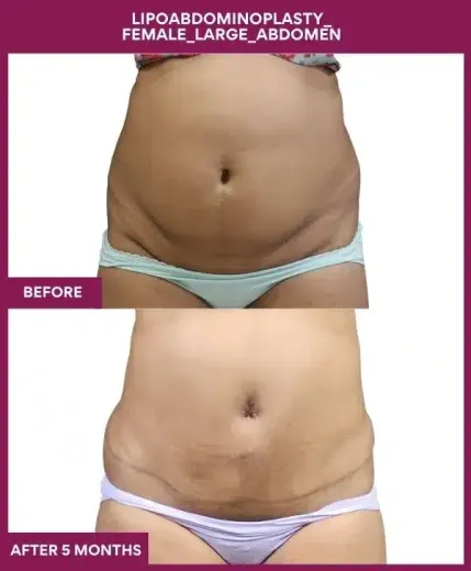 12 Lipoabdominoplasty_ Female_Large_Abdomen_36_ (1)