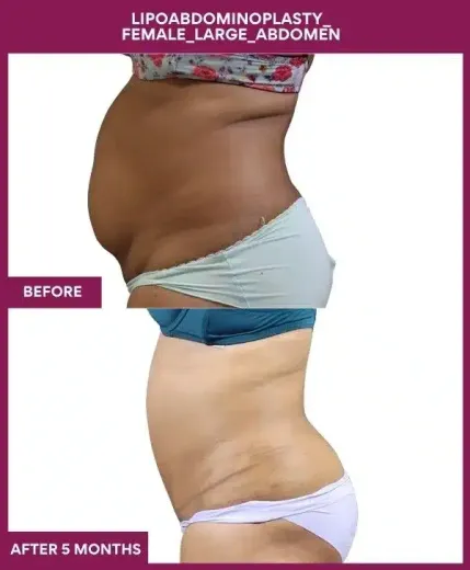 12 Lipoabdominoplasty_ Female_Large_Abdomen_36_ (2)