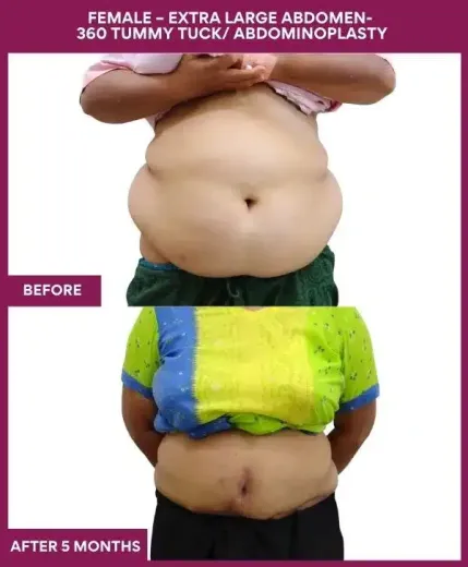 14 FEMALE – EXTRA LARGE ABDOMEN- 360 TUMMY TUCK_ ABDOMINOPLASTY_42