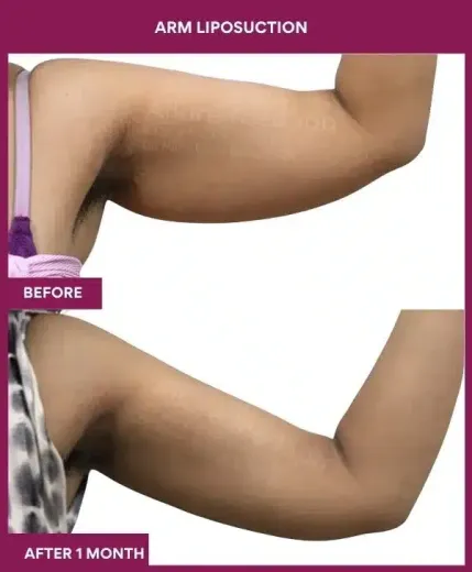 14-arm LIPOSUCTION