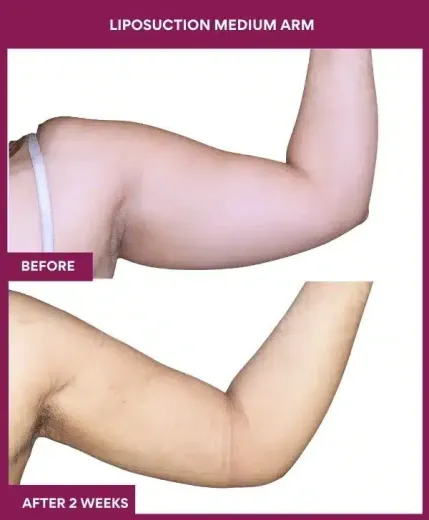 17 LIPOSUCTION MEDIUM ARM-