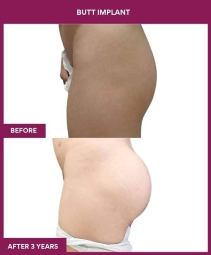 BUTT IMPLANT in Mumbai, India