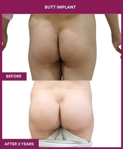 BUTT IMPLANT in Mumbai, India