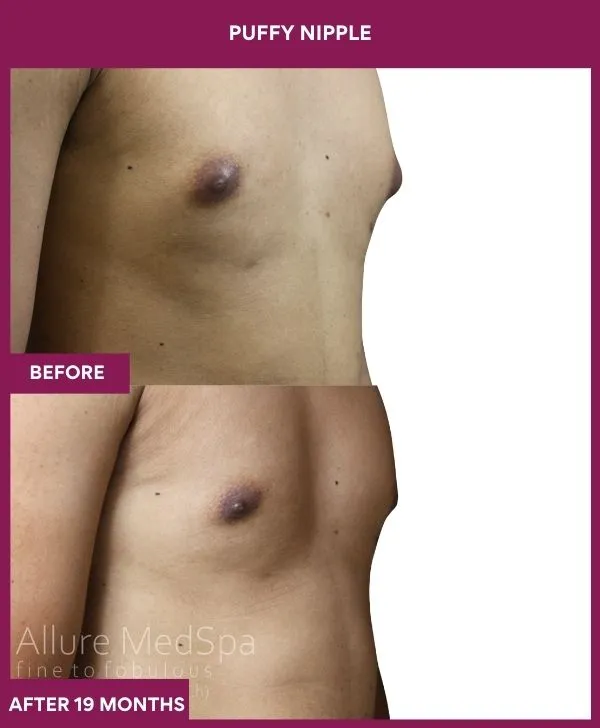 2 PUFFY NIPPLE (4)_66