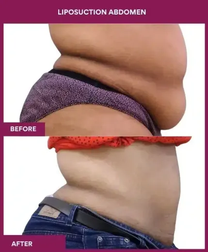 2- liposuction abdomen-