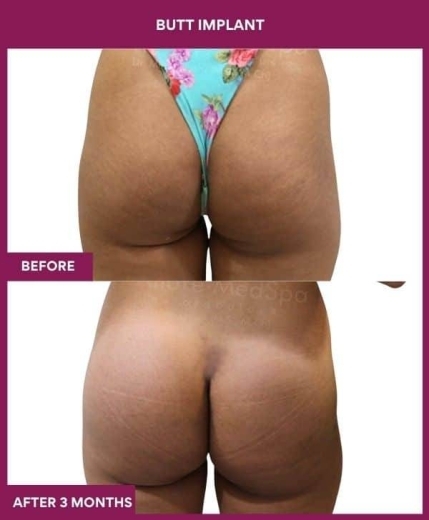 3 BUTT IMPLANT in Mumbai, India