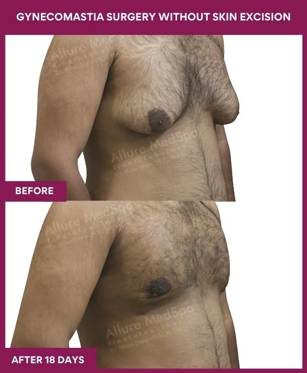 3 Gynecomastia Surgery without Skin excision_50_ (2)